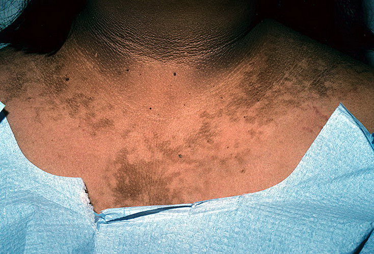 Acanthosis 