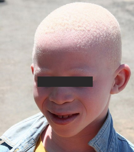 albinizm 