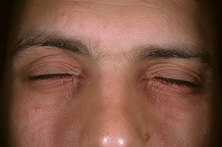 alergia na kosmetyki oczy
