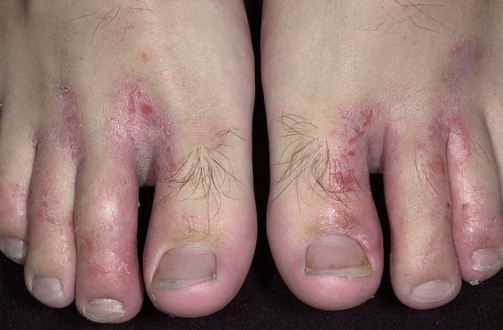 alergia skóry nóg