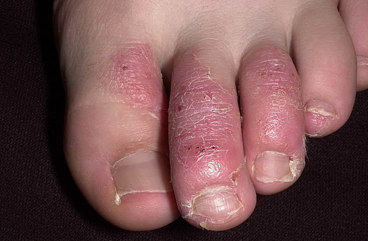alergia skóry palców 