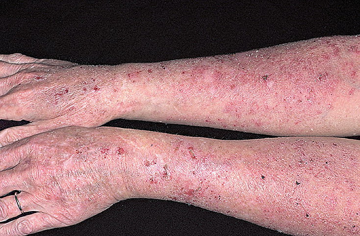 alergiczna choroba skóry