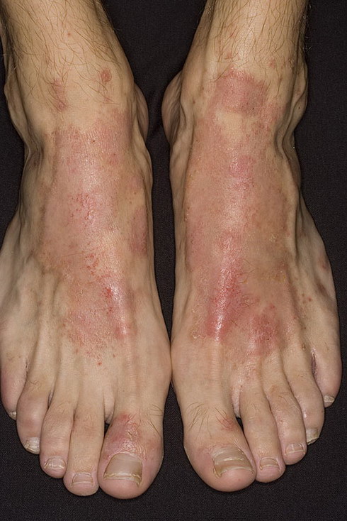 alergiczne kontaktowe zapalenie skóry na stopie