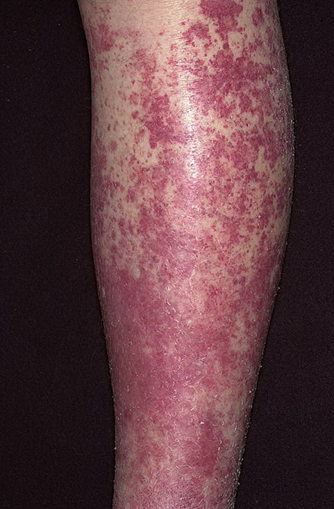 alergiczne zapalenie naczyń krwionośnych na nodze
