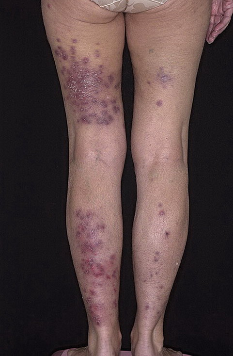 alergiczne zapalenie naczyń krwionośnych na nogach