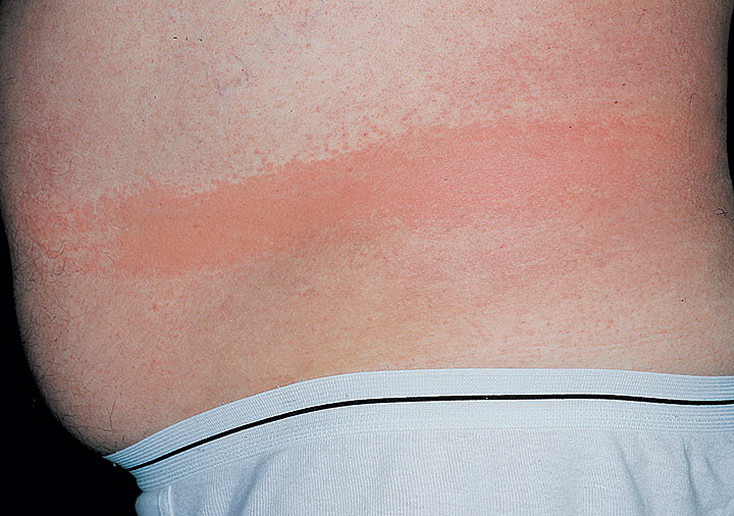 alergiczne zapalenie skóry na lateks