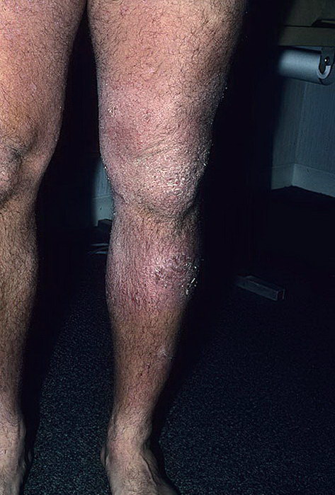 Alergiczne zapalenie skóry nogi