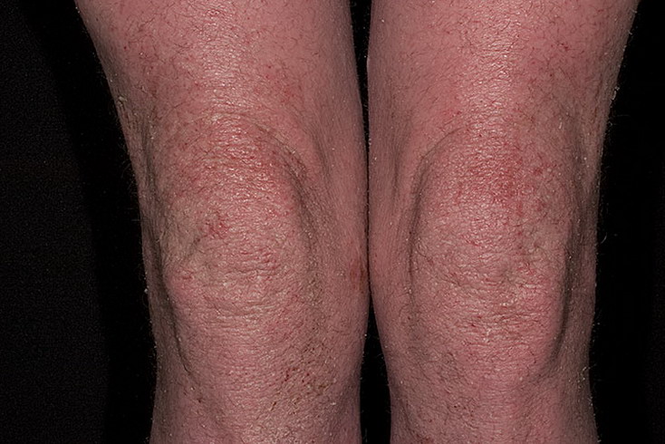 atopowe zapalenie skóry kolana