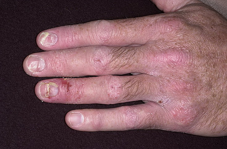atopowe zapalenie skóry na paznokciach