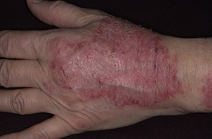 atopowe zapalenie skóry na rękach