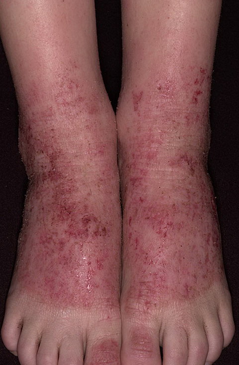 atopowe zapalenie skóry na stopach
