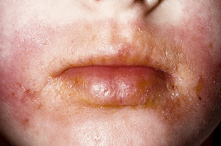 atopowe zapalenie skóry okolice ust