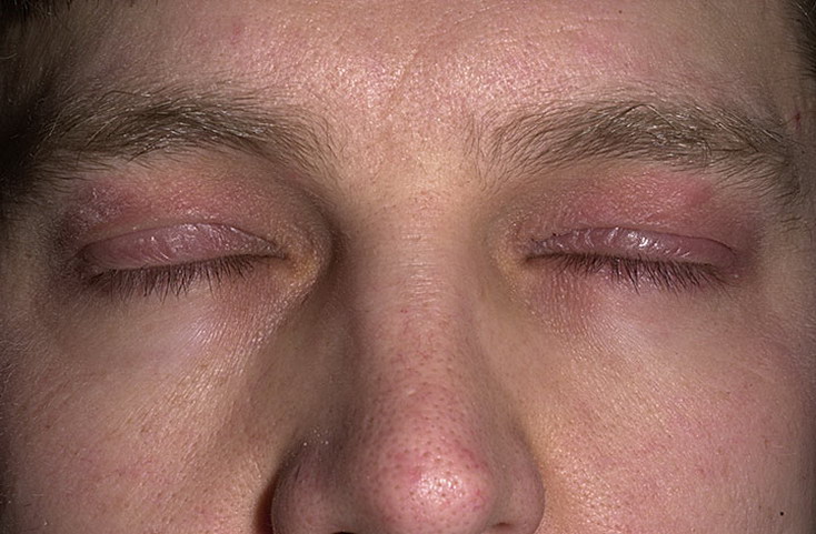 atopowe zapalenie skóry wokół oczu