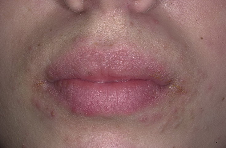 atopowe zapalenie skóry wokół ust