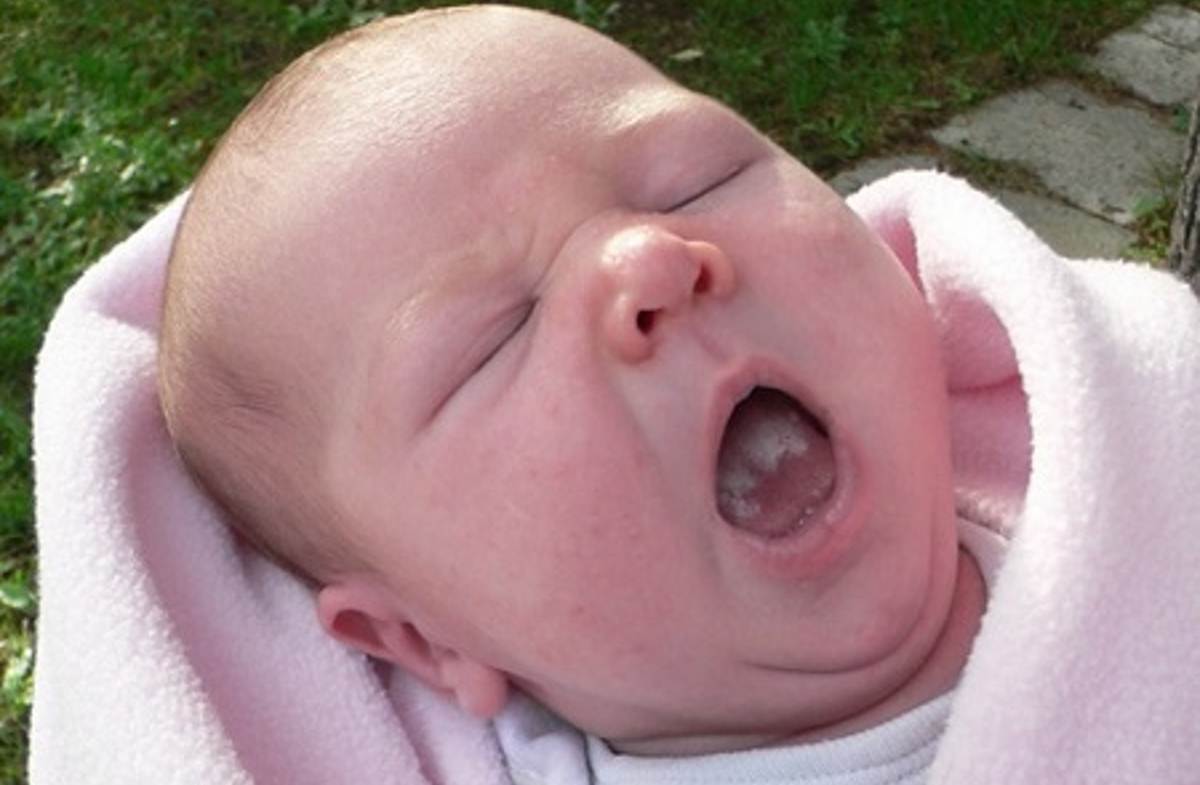 biały język u noworodków