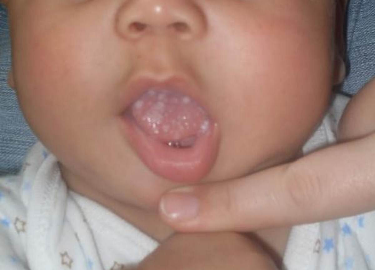 biały nalot w jamie ustnej u niemowlaka