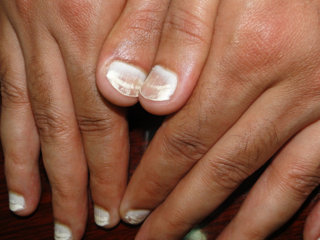 biały paznokieć