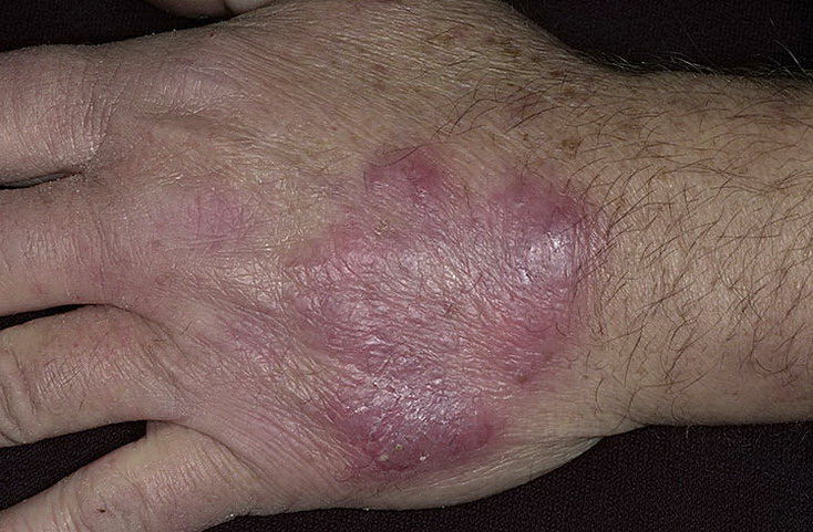 choroba grzybicza dłoni