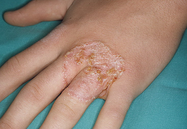 choroba grzybicza dłonie
