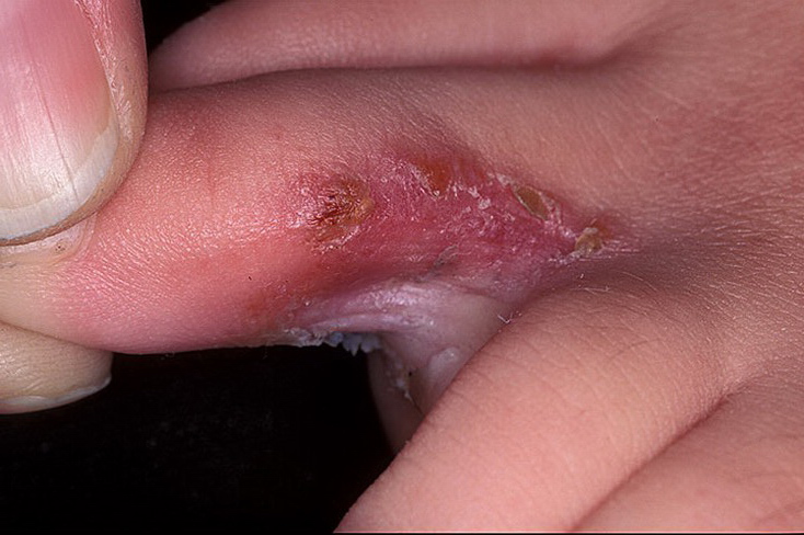 choroba grzybicza między palcami
