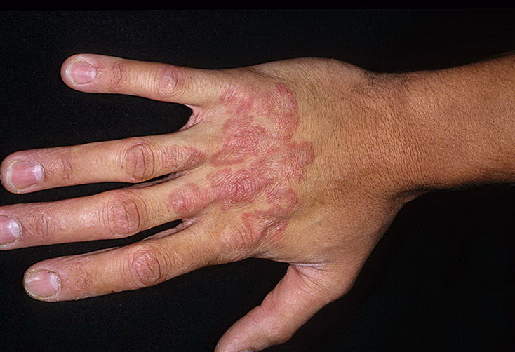 choroba grzybicza na dłoniach