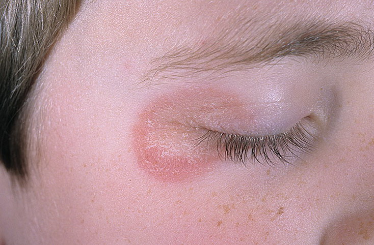 choroba grzybicza oka
