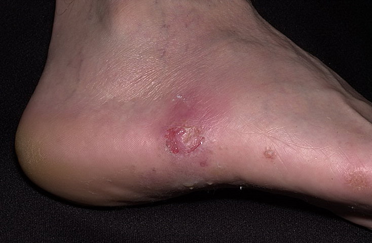 choroba grzybicza stopy
