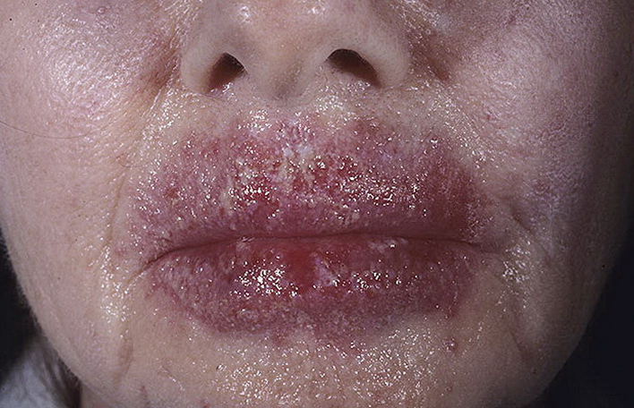choroba grzybicza usta