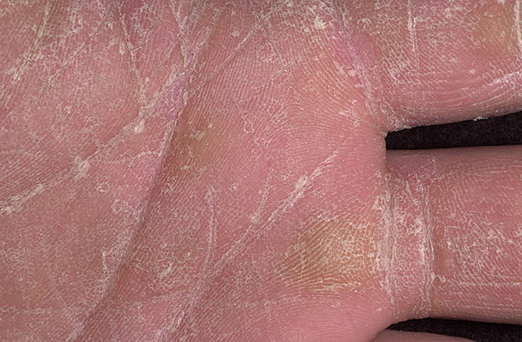 choroba grzybicza węwnętrzna część dłoni