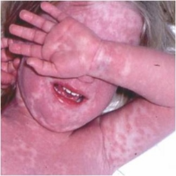 choroba kawasaki na całym ciele skóra