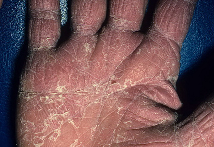 choroby dłoni