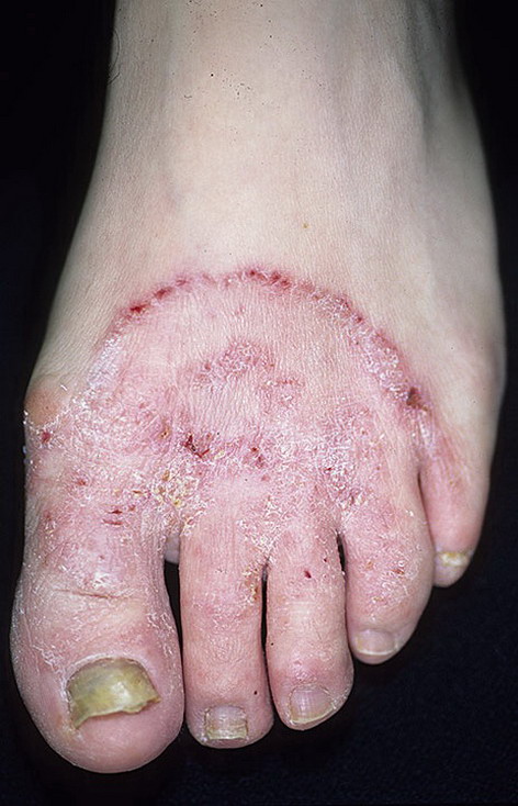 Choroby grzybowe grzybicy skóry stóp