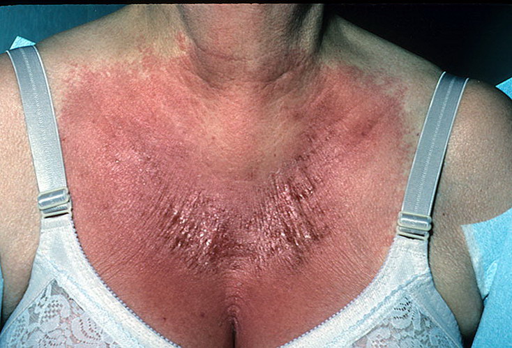 choroby skóry klatka piersiowa
