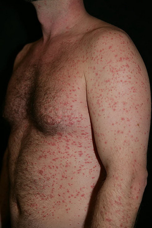 choroby skóry łuszczyca