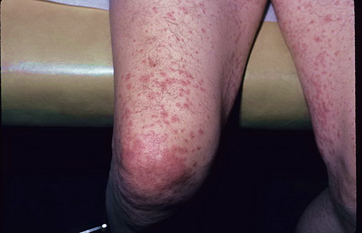 choroby skóry łuszczyca kolano