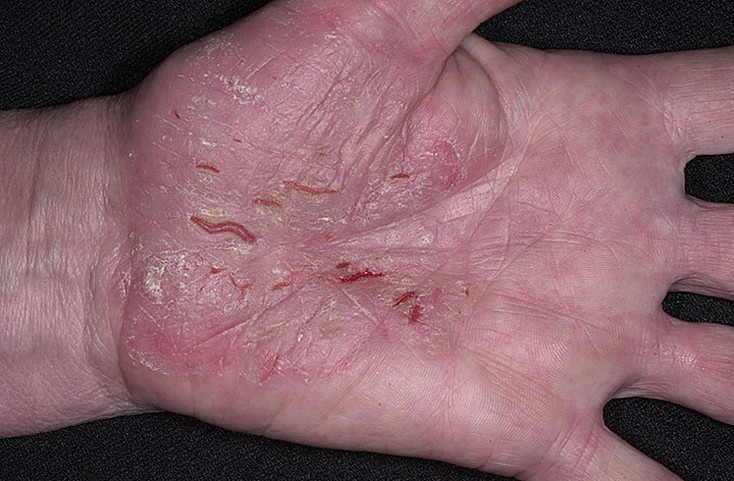 choroby skóry łuszczyca na dłoni