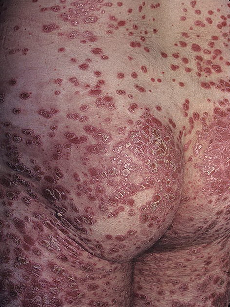 choroby skóry łuszczyca pośladki
