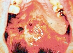 czerniak jamy ustnej foto