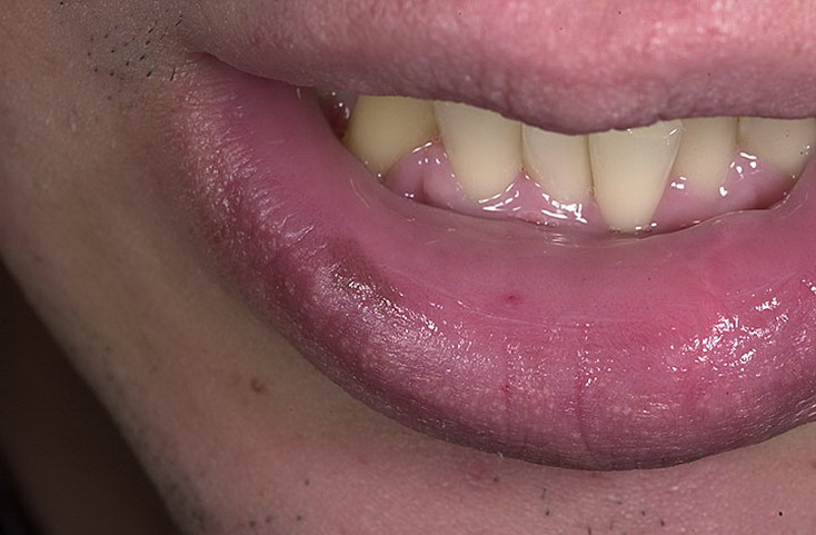 czerniak na ustach zdjęcia