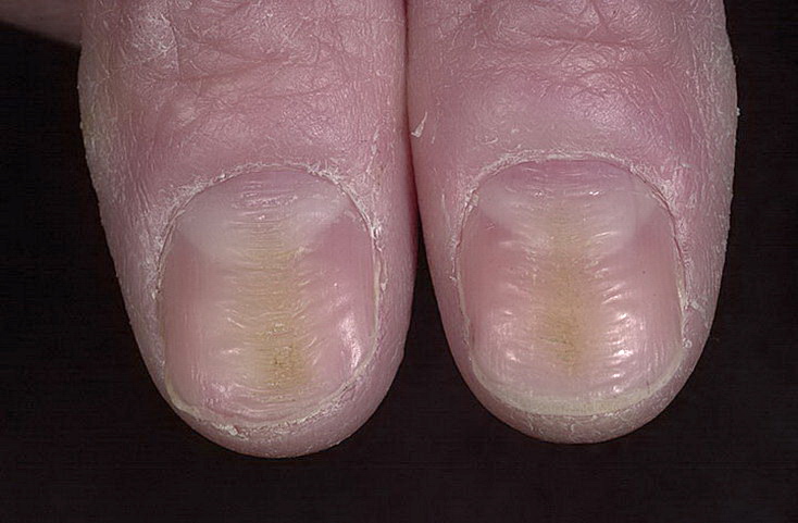 deformacja paznokci