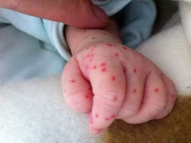 denga u dzieci