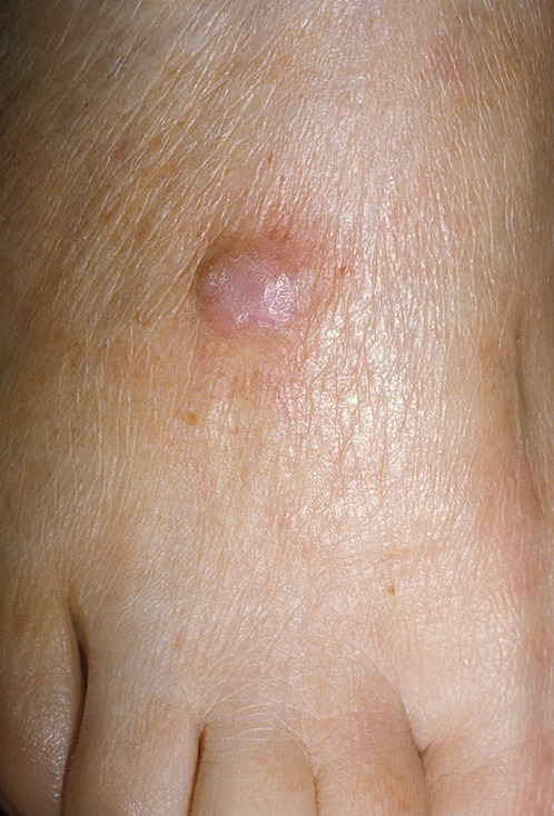 dermatofibroma włókniak na stopie