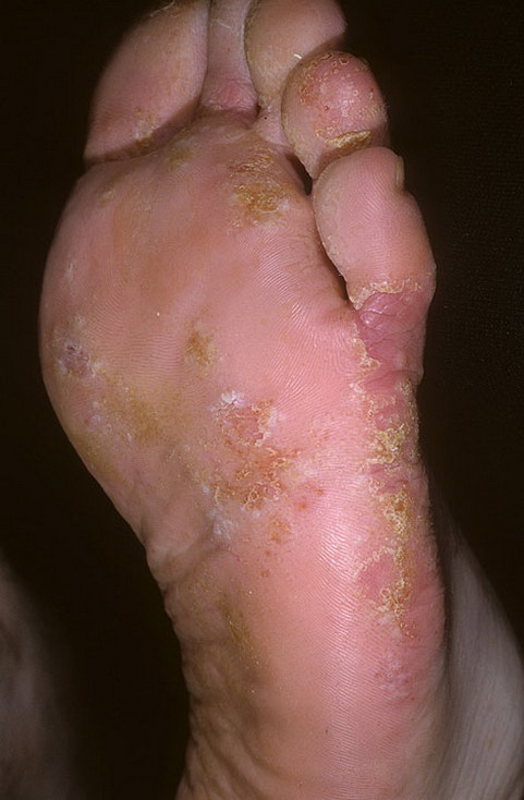 dyshidrosis feet