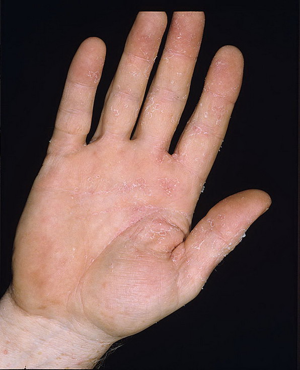 dyshidrosis fingernail
