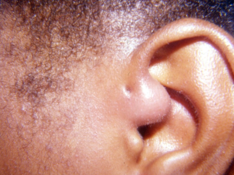dziurka powyżej uszu