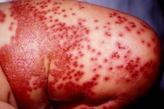 eczema herpeticum