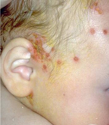 eczema herpeticum