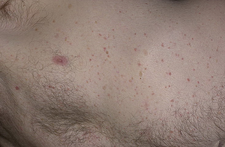 grovers skin disease pictures