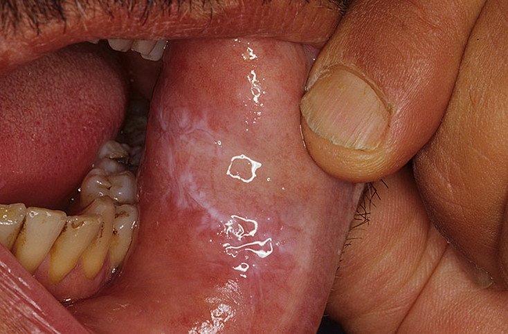 grzybica jamy ustnej objawy zdjęcia
