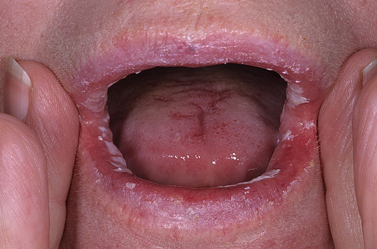 grzybica jamy ustnej zaraźliwa